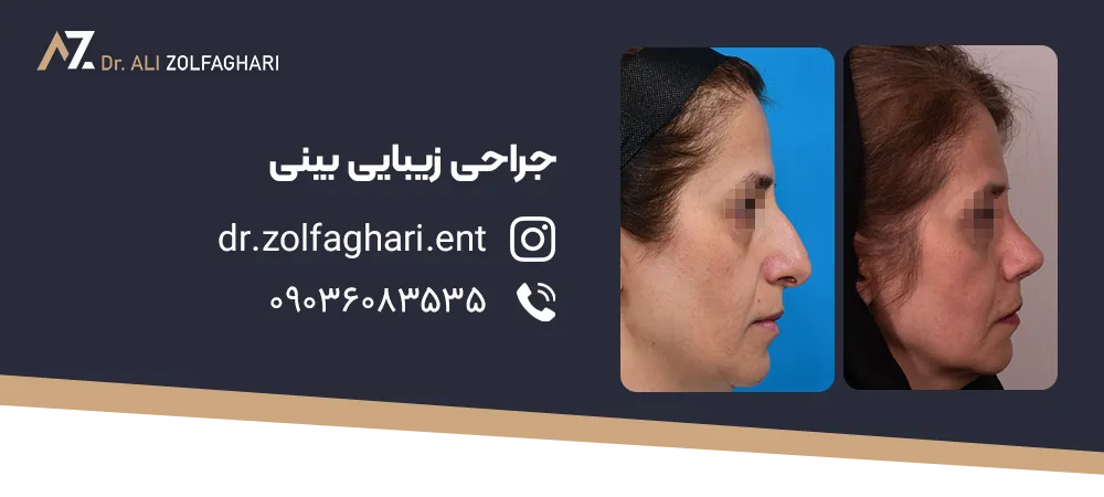 مراقبتهای بعد از عمل قوز بینی