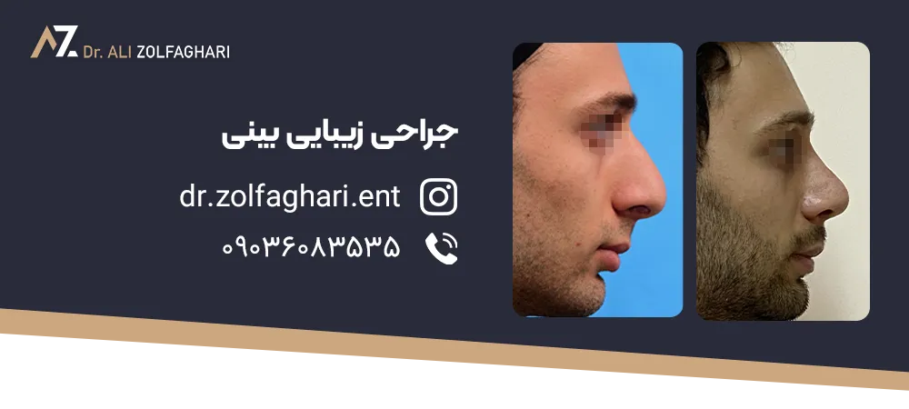 انواع قوز بینی