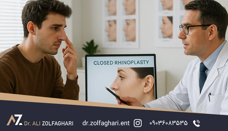 عمل قوز بینی با رینوپلاستی بسته