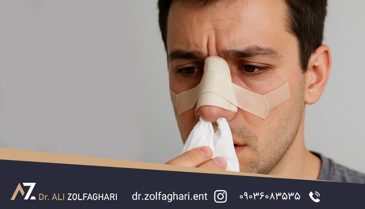 آبریزش بینی بعد از رینوپلاستی