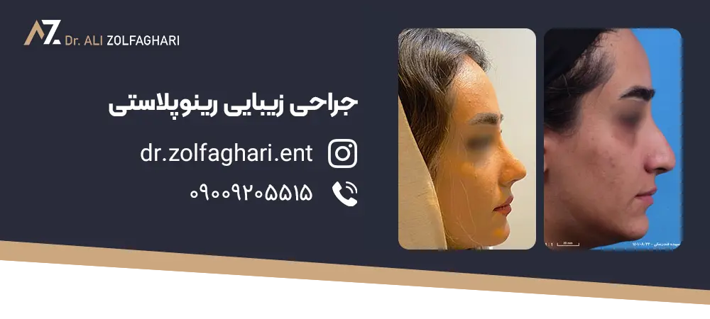 عکس قبل و بعد رینو