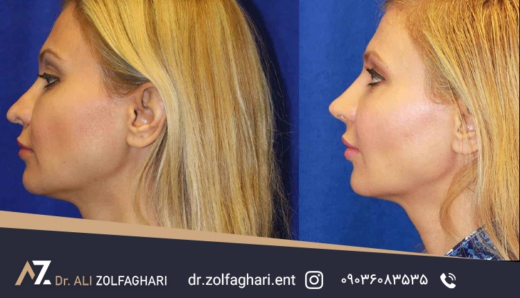 پیوند غضروف گوش در جراحی رینوپلاستی 