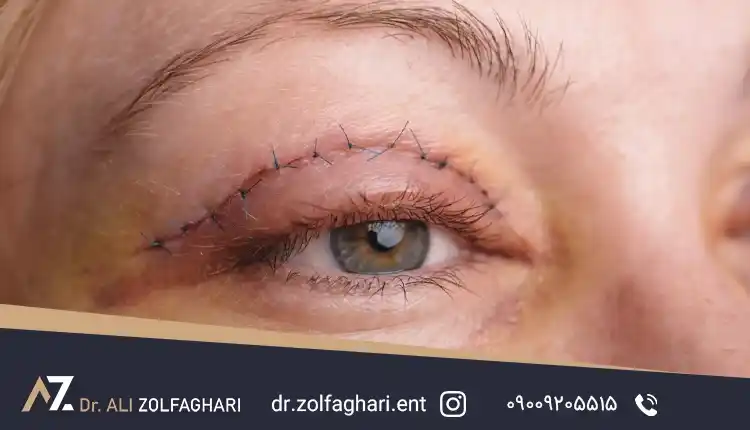 جراحی پلک ترمیمی