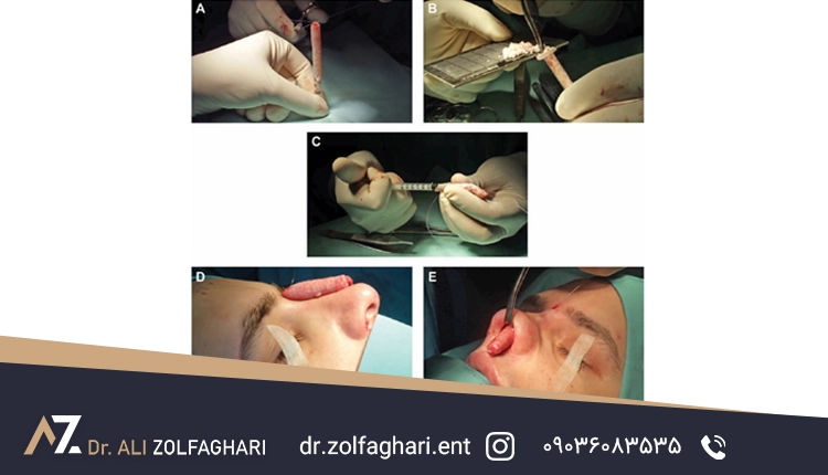 مراحل انجام پیوند غضروف دنده به بینی