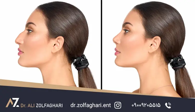 رینوپلاستی مدرن یا جراحی کلاسیک بینی