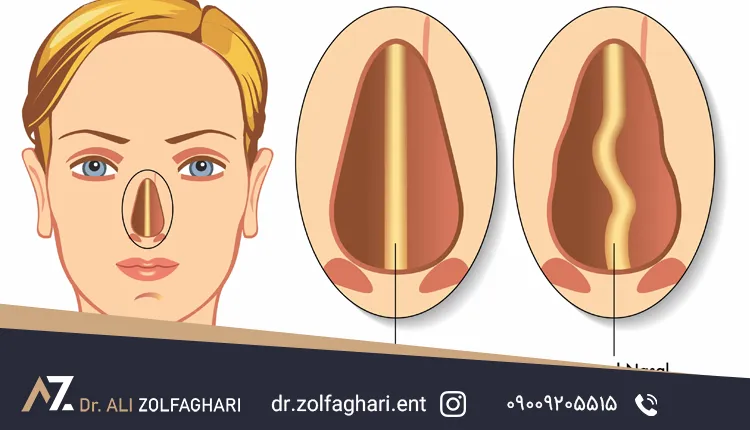 سپتوپلاستی چیست؟