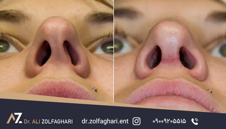 عمل سپتوپلاستی چگونه انجام میشود؟