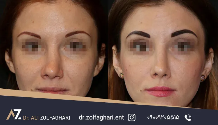 ویژگی جراحی سپتوپلاستی بینی