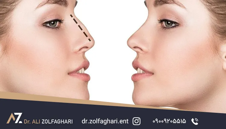 تفاوت سپتوپلاستی و سپتورینوپلاستی
