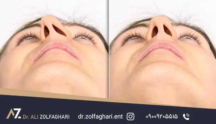 سپتوپلاستی: جراحی اصلاح انحراف تیغه بینی