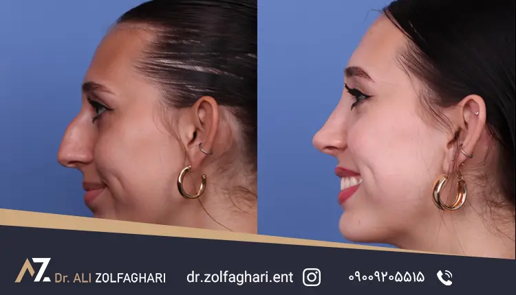 تفاوت سپتوپلاستی و سپتورینوپلاستی در جراحی زیبایی بینی