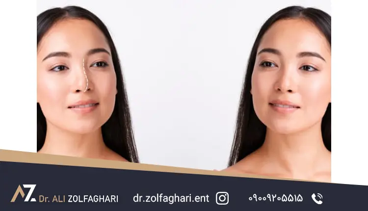 فواید زیبایی و روانشناختی قوز بینی