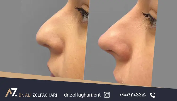 تفاوت بین قوز طبیعی بینی و غیرطبیعی