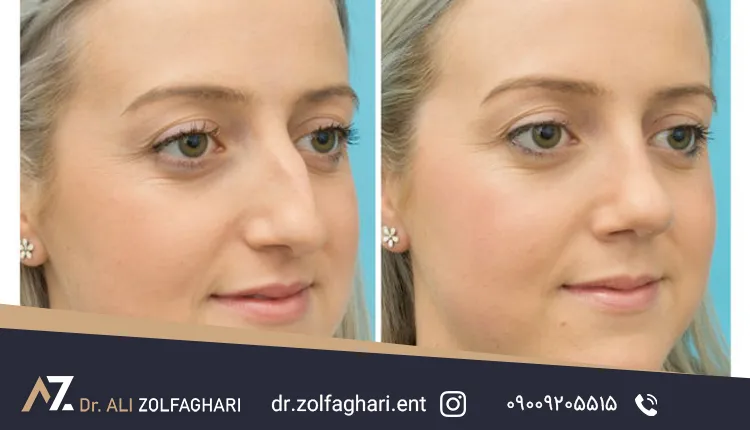 آیا انحراف بینی بعد از جراحی برمیگردد؟ بررسی دلایل و راههای پیشگیری آیا انحراف بینی بعد از جراحی برمیگردد؟ بررسی دلایل و راههای پیشگیری