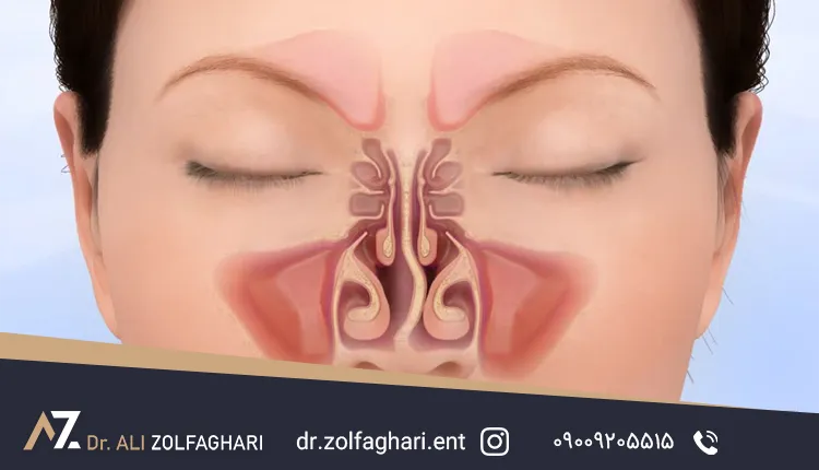 انحراف سپتوم بینی