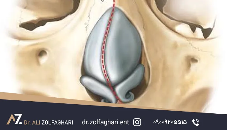 انحراف سپتوم به شکل کمان