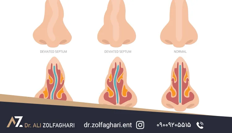 انحراف تیغه بینی به شکل S