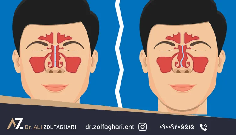 انحراف تیغه بینی