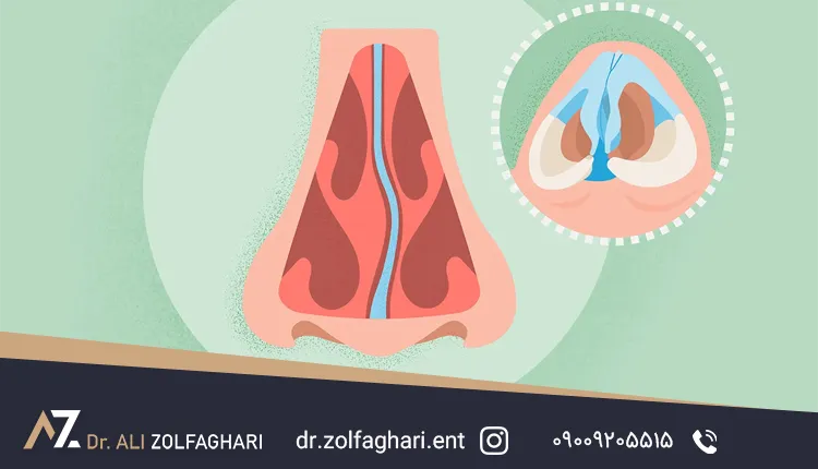 خطرات احتمالی انحراف بینی