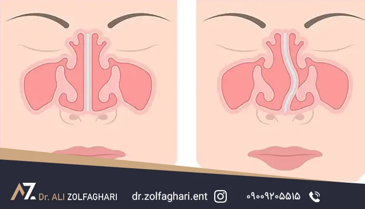 علائم رایج انحراف بینی و تیغه بینی کج