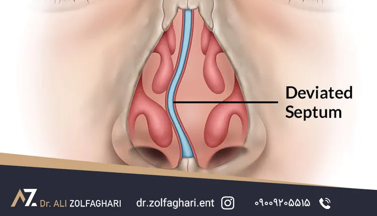 انحراف بینی (انحراف سپتوم بینی) چیست؟ راهنمای کامل علائم و تشخیص