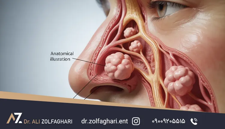 چگونه انحراف بینی را از پولیپ بینی تشخیص دهیم؟
