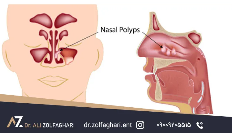 چگونه انحراف بینی را از پولیپ بینی تشخیص دهیم؟