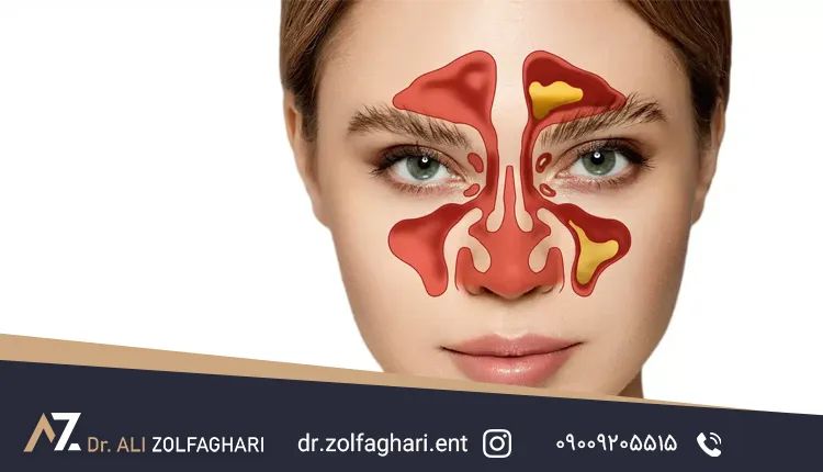 تاثیر انحراف بینی بر چشم تاثیر انحراف بینی بر چشم